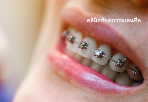 orthodontics treatment คลินิกทันตกรรมเดนทีค