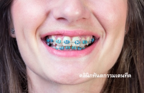 orthodontics treatment คลินิกทันตกรรมเดนทีค